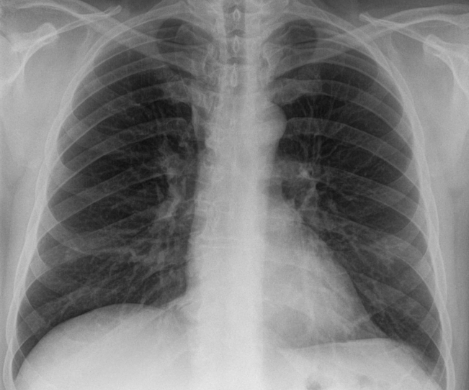 An x-ray of popcorn lungs. 